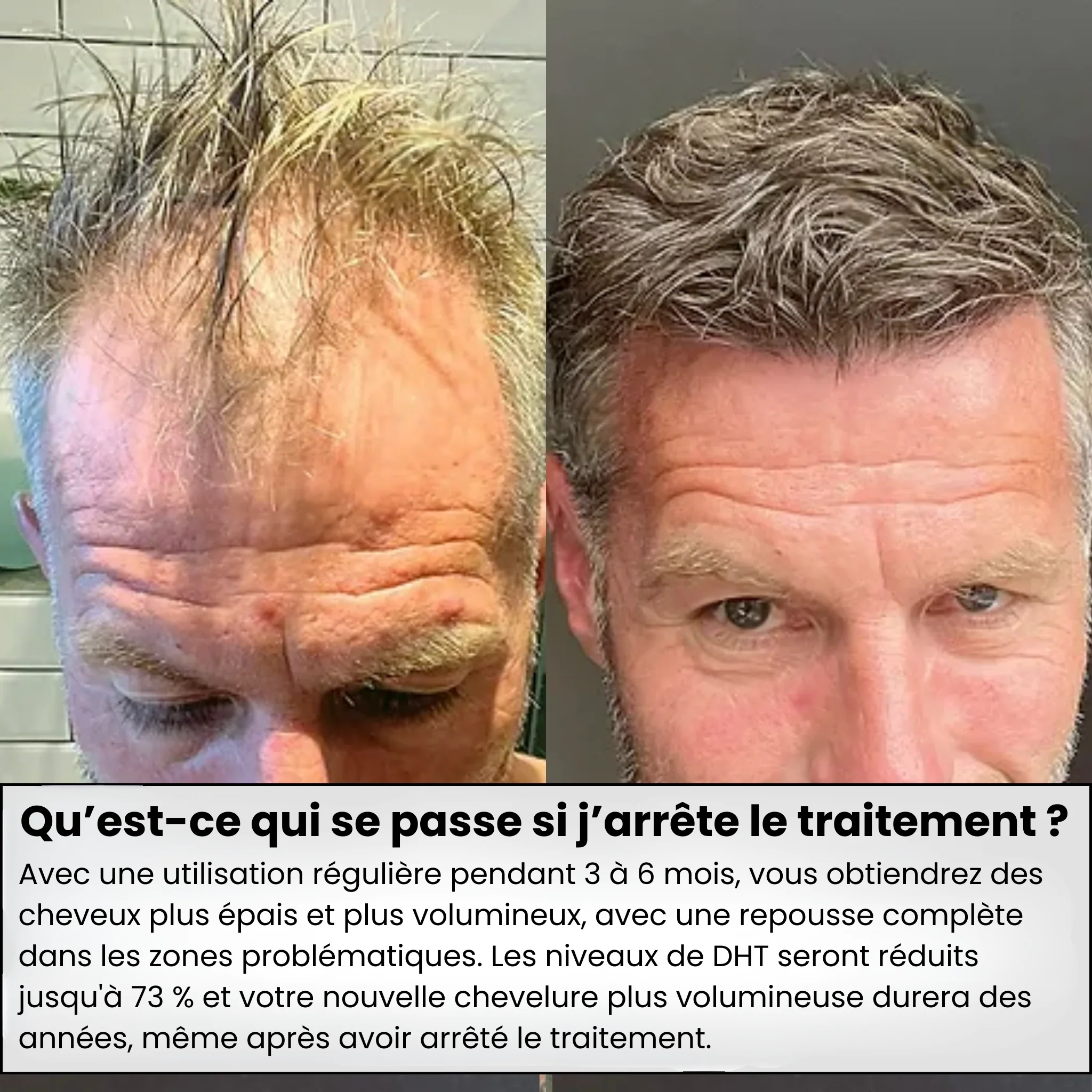 Système de Micro-Infusion Capillaire™ - Lerelia